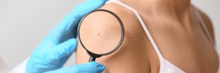 Cancer de la peau : un vaccin personnalisé franchit une étape historique